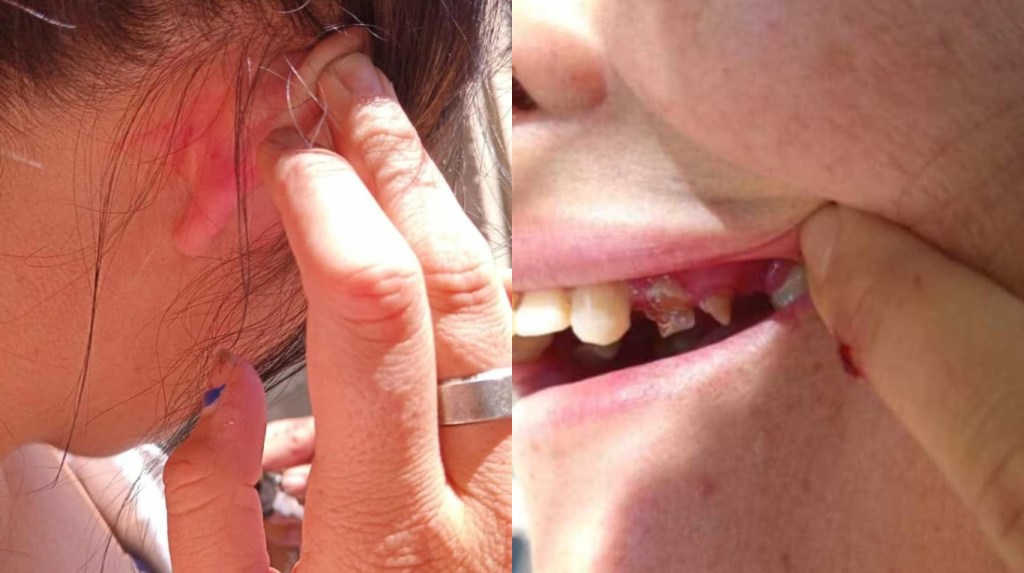 «Casi la matan»: una joven denunció que cuatro mujeres le dieron una brutal golpiza en la puerta de un boliche de&nbsp;Junín